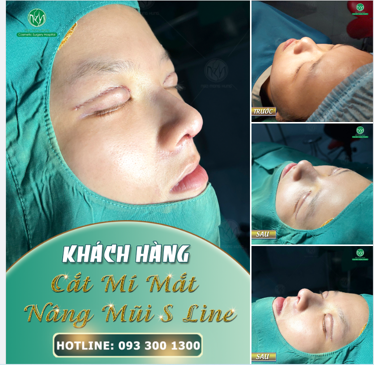 MỘT CA NÂNG MŨI KẾT HỢP CẮT MÍ MẮT