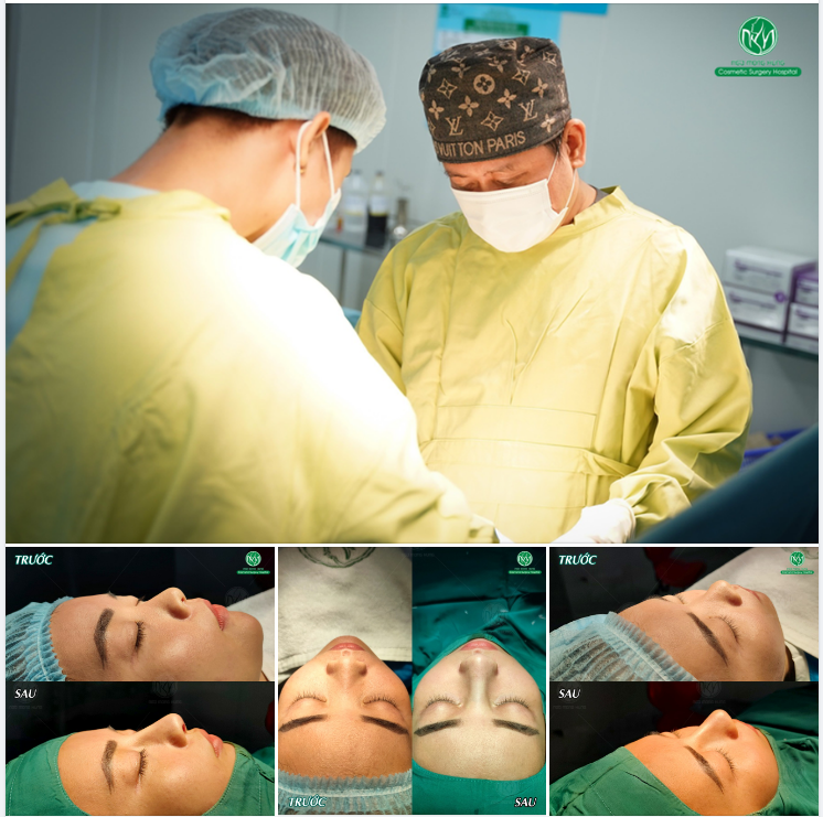 MỘT CA NÂNG MŨI MEGADERM TIÊU BIỂU