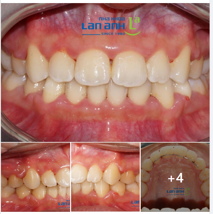  Một ca niềng lại vì thất bại từ niềng nơi khác, tại nha khoa Lan Anh chi nhánh Phú Nhuận!