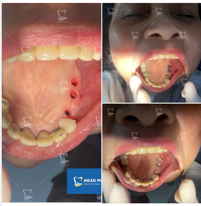 Một cây làm chẳng nên non - Ba cây chụm lại nên hàm răng xinh
