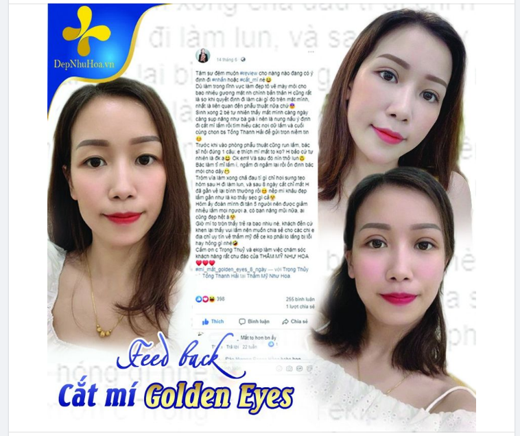 Một feedback đáng yêu, chân thật từ nữ khách hàng Cắt mí Golden Eyes tại Thẩm mỹ Như Hoa