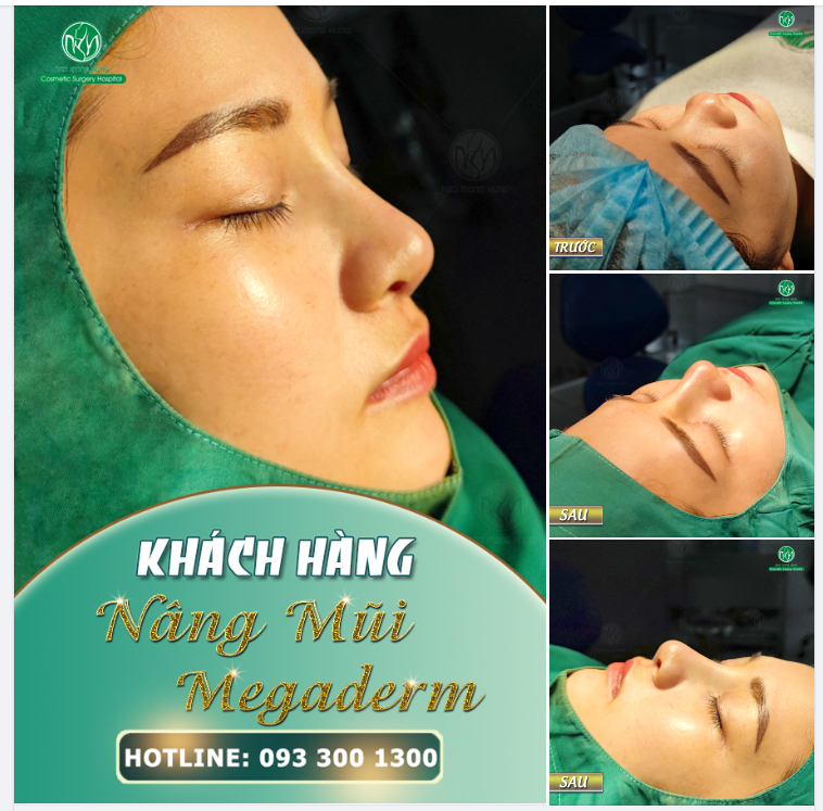 MỘT KẾT QUẢ SAU NÂNG MŨI MEGADERM