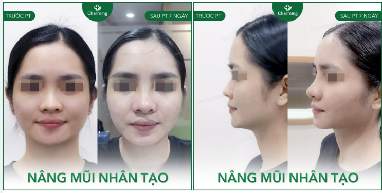 Một minh chứng cho thấy nâng mũi nhân tạo cũng sang-xịn-mịn như ai đây ạ