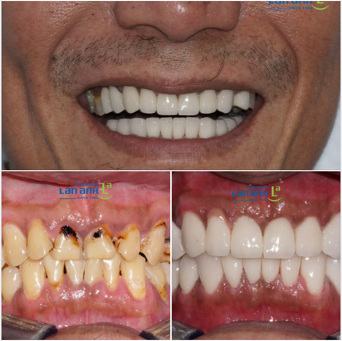 Một trường hợp làm răng sứ thẩm mỹ của bác sĩ Phúc, chi nhánh Phú Nhuận!