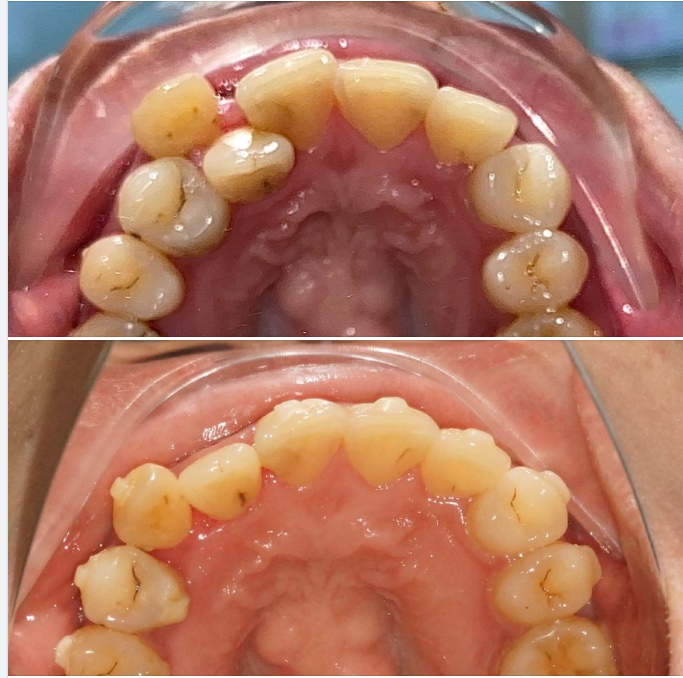 Một trường hợp niềng Invisalign của bác sĩ Tuấn Anh, chi nhánh Phú Mỹ Hưng, Q.7!