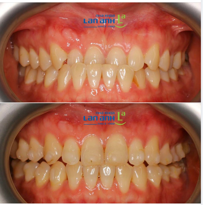 Một trường hợp niềng Invisalign tại chi nhánh Sala, quận 2, bác sĩ Tuấn Anh