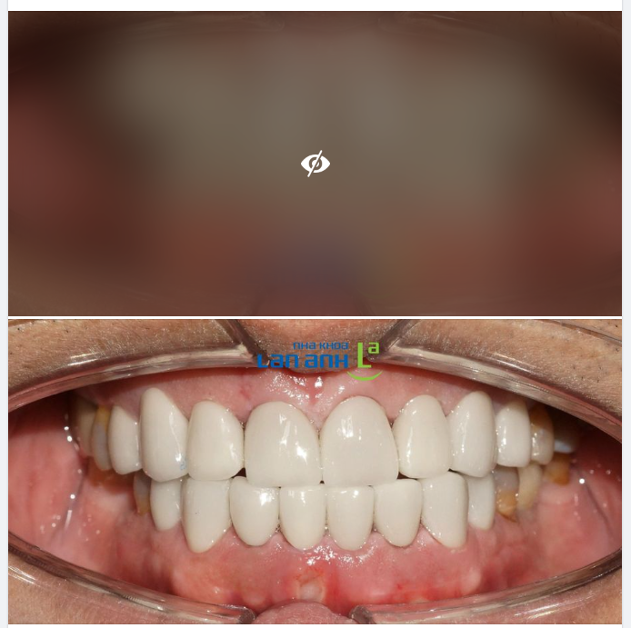 Một trường hợp thay thế đắp mặt Composite bằng Veneer sứ, tại nha khoa Lan Anh Phú Mỹ Hưng, Q.7 của bác sĩ Tú!