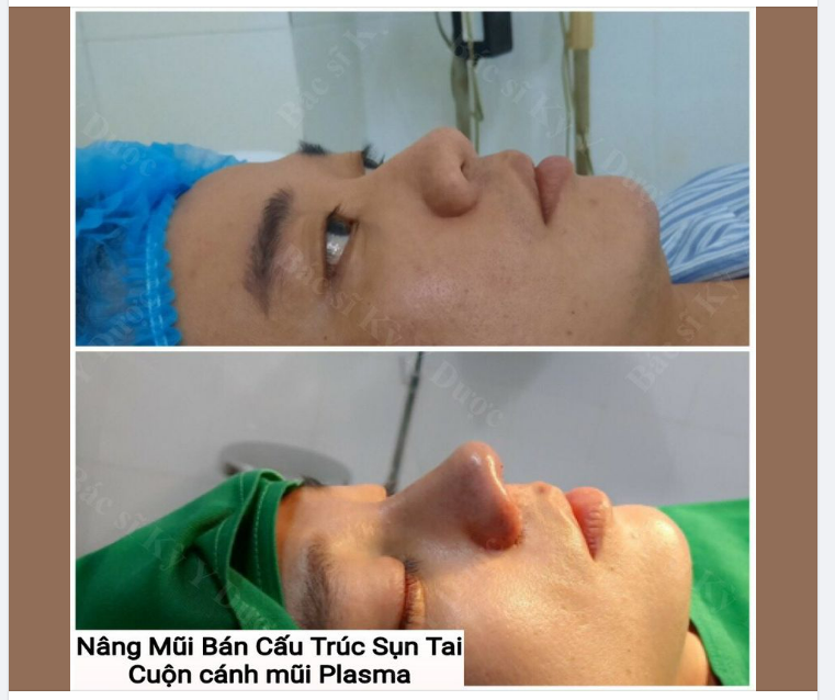 MŨI BÁN CẤU TRÚC SỤN TAI KẾT HỢP CUỘN CÁNH MŨI PLASMA - ĐẸP CHUẨN NAM THẦN