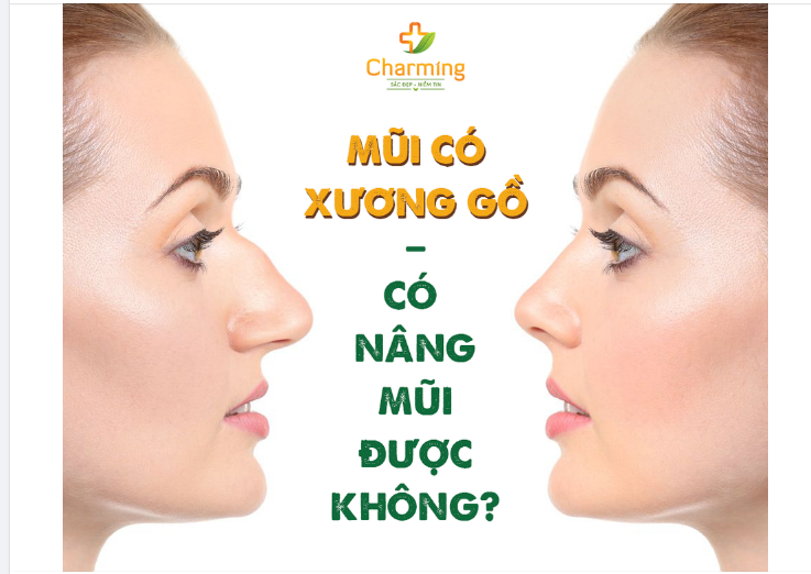 MŨI CÓ GỒ CÓ NÂNG MŨI ĐƯỢC KHÔNG