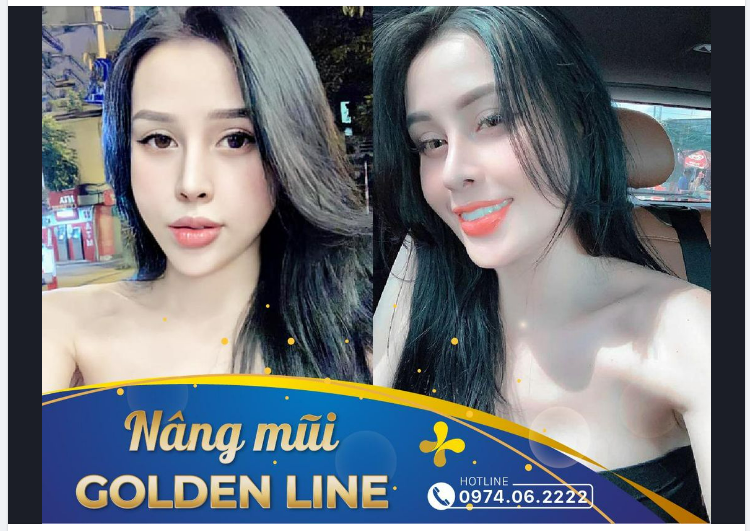 Mũi Golden Line đẹp từ góc thẳng đến góc nghiêng, từ lúc vừa nâng đến sau 1 năm vẫn duy trì ổn định.