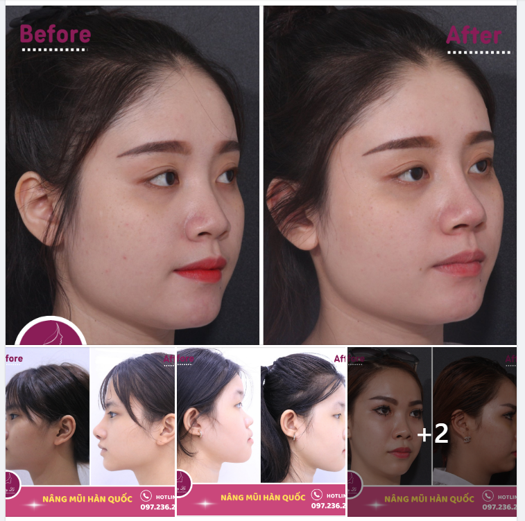 MŨI HÀN QUỐC “GIÁ XẸP” VẪN LÊN FORM CỰC ĐẸP