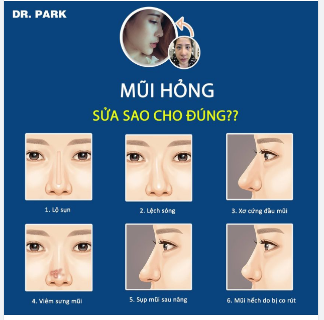 MŨI HỎNG - SỬA SAO CHO ĐÚNG