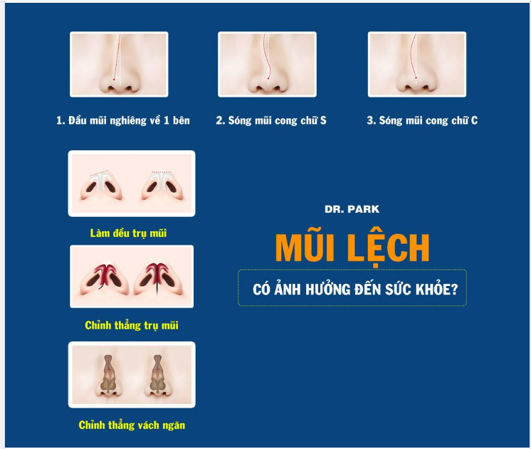 MŨI LỆCH - CÓ ẢNH HƯỞNG ĐẾN SỨC KHỎE