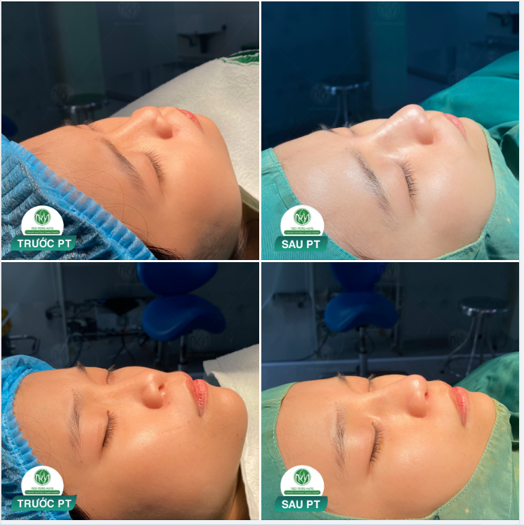 MŨI MEGADERM CAO NHẸ NHÀNG NHƯNG VẪN NỔI BẬT