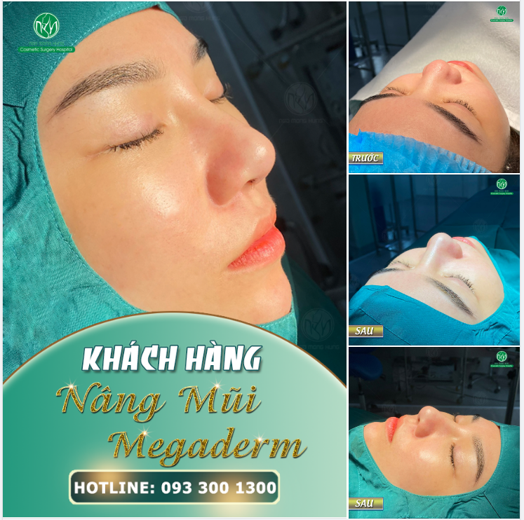 MŨI MEGADERM CHO KH 23 TUỔI