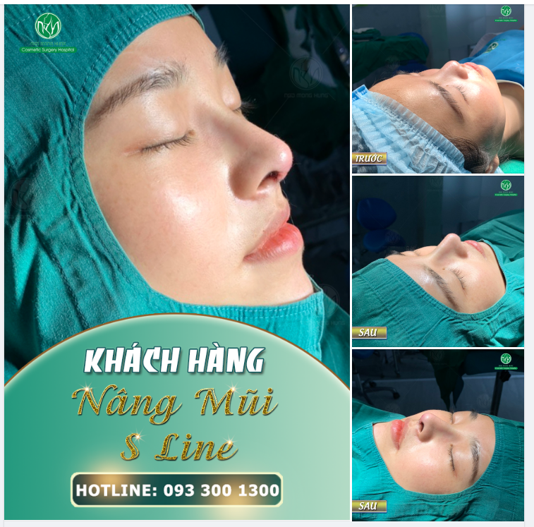 MŨI S LINE CHO DÁNG MŨI CAO THANH THOÁT