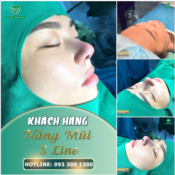 MŨI S LINE ĐẸP MỌI GÓC ĐỘ