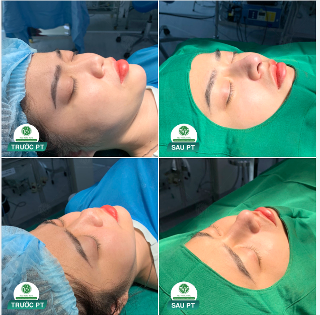 MŨI S LINE SIÊU ĐẸP CHO KHÁCH HÀNG