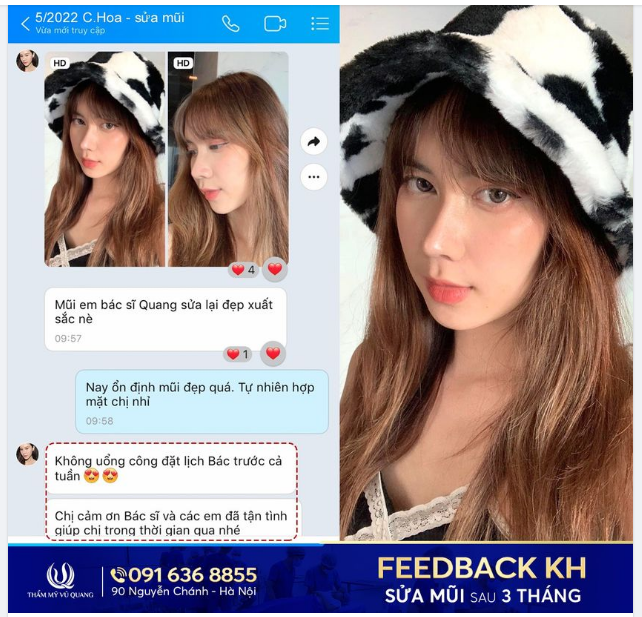 Nàng CEO đẹp xuất thần sau khi được Bác sĩ Vũ Quang sửa lại mũi.