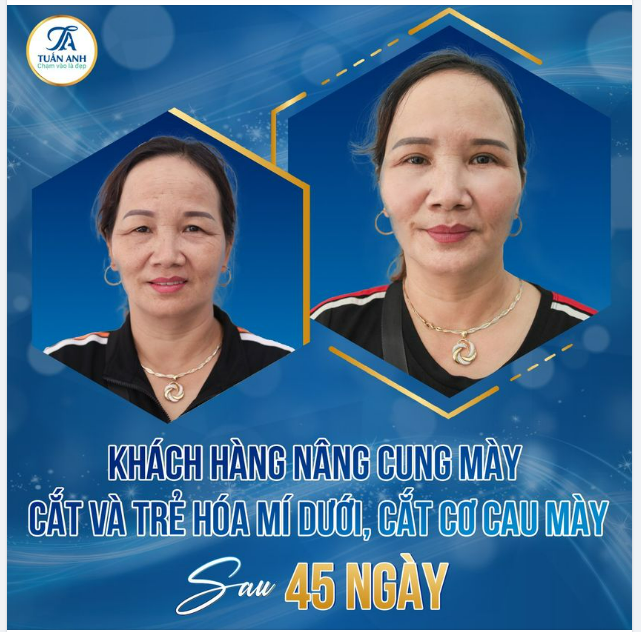NÂNG CUNG MÀY + CẮT TRẺ HÓA MÍ DƯỚI + XÓA NHĂN CƠ CAU MÀY- Giải pháp lấy lại nét tươi trẻ cho khuôn mắt
