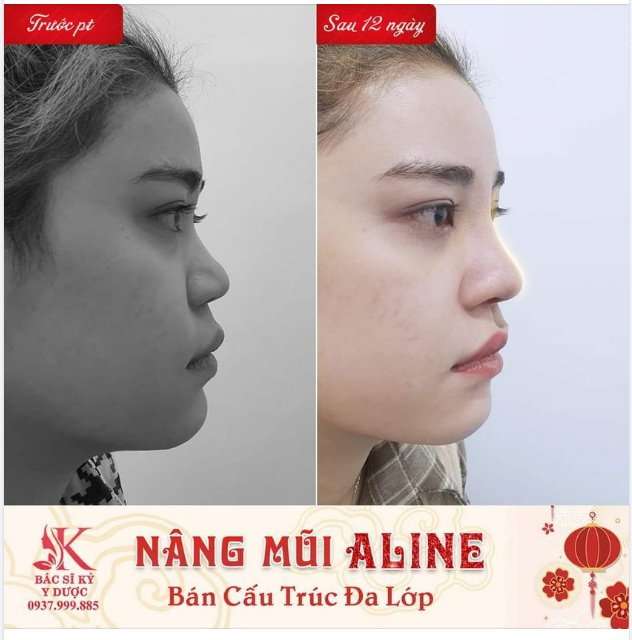NÂNG MŨI ALINE BÁN CẤU TRÚC ĐA LỚP - DÁNG MŨI VẠN NGƯỜI MÊ - CHỈ SAU 12 NGÀY