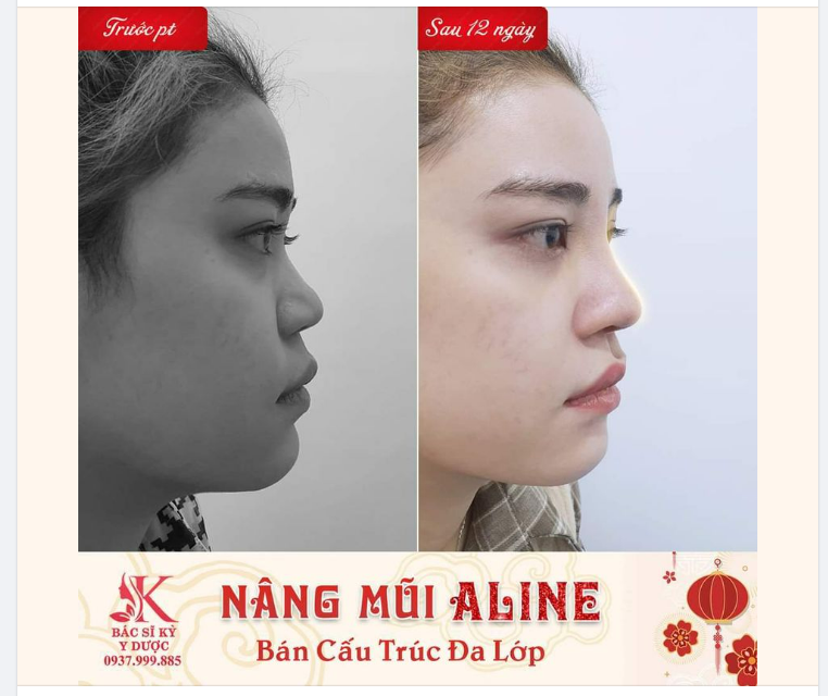 NÂNG MŨI ALINE BÁN CẤU TRÚC ĐA LỚP - DÁNG MŨI VẠN NGƯỜI MÊ
