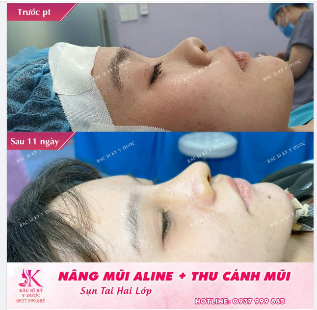 Nâng mũi Aline là phương pháp nâng mũi mới nhất, và hiện đại nhất.