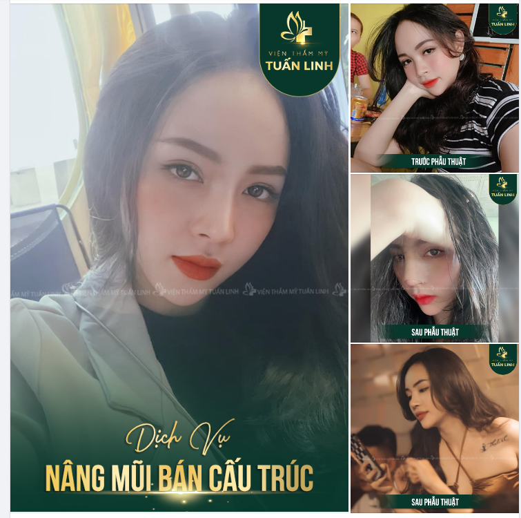 Nâng mũi bán cấu trúc dáng tự nhiên nhưng vẫn giúp khuôn mặt sắc nét hơn.