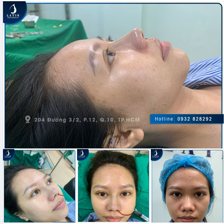 NÂNG MŨI BÁN CẤU TRÚC - PHONG THỦY TÀI LỘC