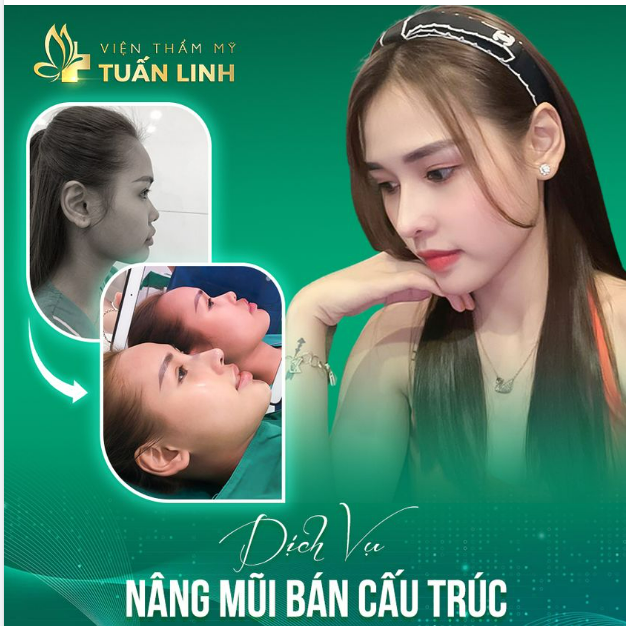 Nâng mũi bán cấu trúc Nâng thần thái đỉnh cao