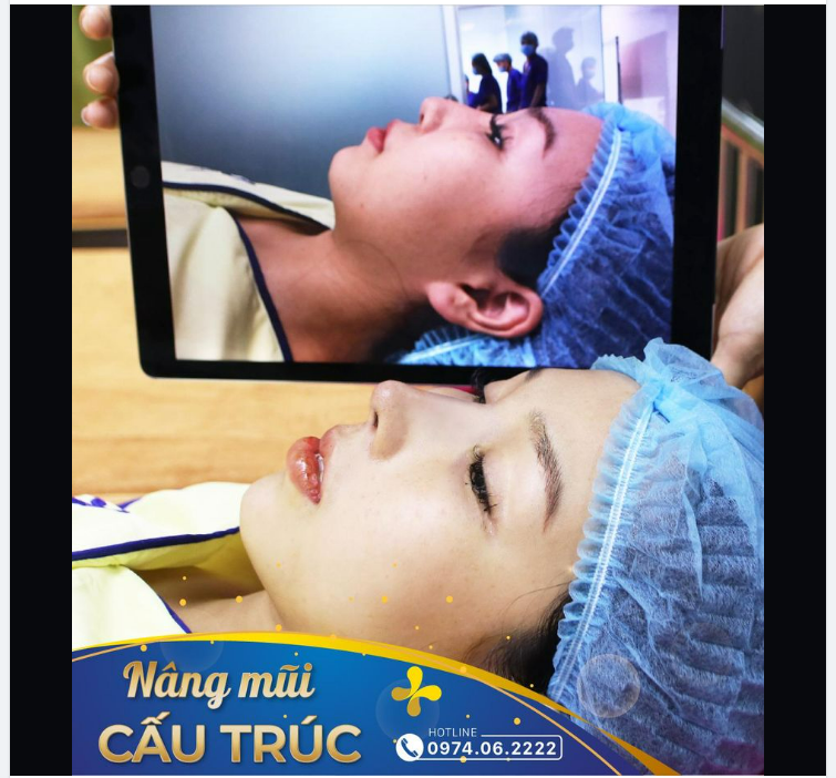 Nâng mũi - Bí kíp thay đổi nhan sắc sau 30 phút.