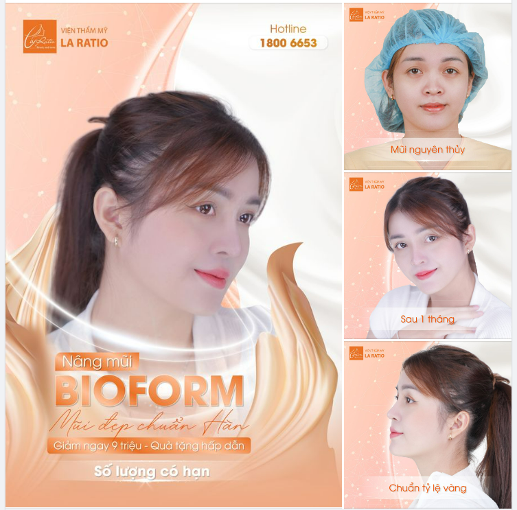NÂNG MŨI BIOFORM – VẺ ĐẸP CHUẨN HÀN