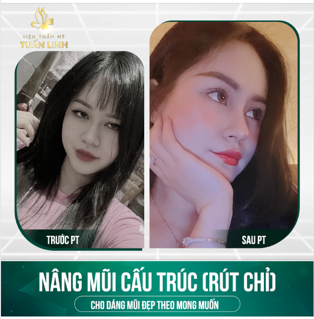 NÂNG MŨI CẤU TRÚC - CHO DÁNG MŨI BỀN ĐẸP CÙNG THỜI GIAN