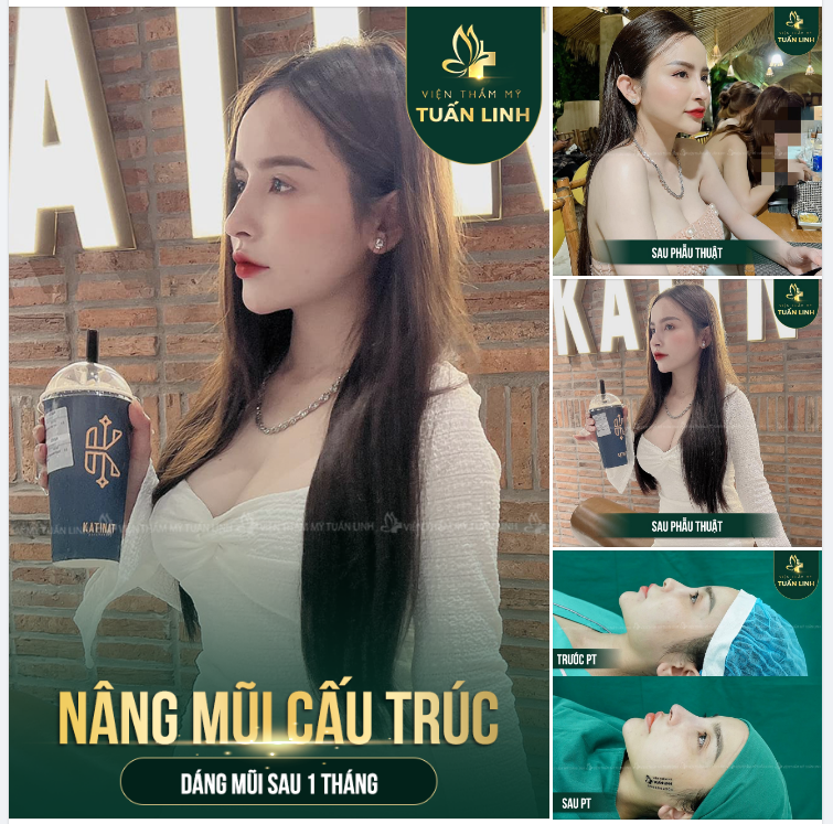 NÂNG MŨI CẤU TRÚC - DÁNG MŨI SAU 1 THÁNG