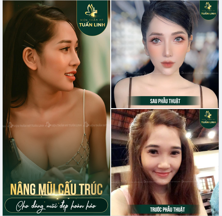 NÂNG MŨI CẤU TRÚC - KHẮC PHỤC HOÀN TOÀN TÌNH TRẠNG MŨI THẤP TẸT, CÁNH MŨI TO BÈ.