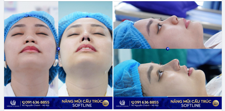 Nâng mũi cấu trúc Softline - Đẹp sang thời thượng