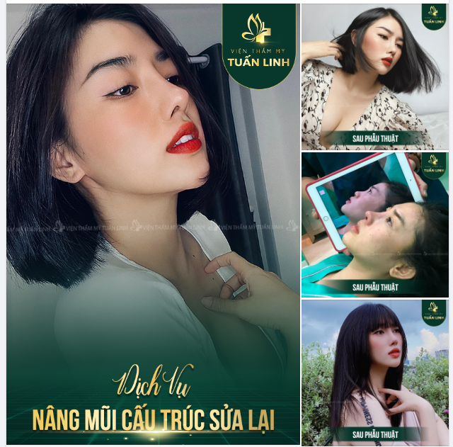 NÂNG MŨI CẤU TRÚC SỬA LẠI - CAO THỜI THƯỢNG - ĐẸP SANG CHẢNH