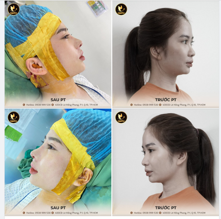 NÂNG MŨI CẤU TRÚC – TÁI TẠO TOÀN DIỆN DÁNG MŨI
