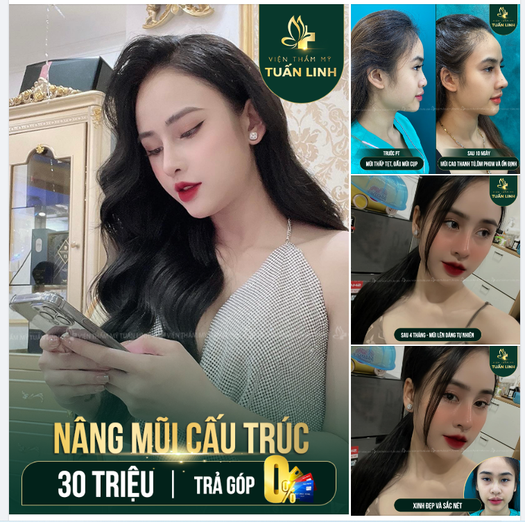 NÂNG MŨI CẤU TRÚC TẠI TUẤN LINH CÓ GÌ KHÁC BIỆT