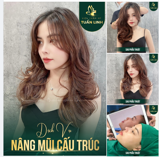 NÂNG MŨI CẤU TRÚC TẠI TUẤN LINH
