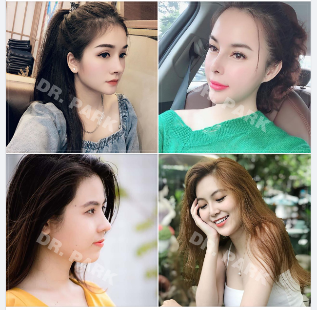 NÂNG MŨI CẤU TRÚC VÌ SAO HOT