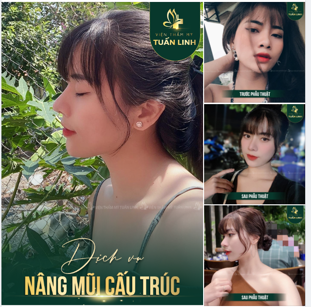 NÂNG MŨI CẤU TRÚC - XU HƯỚNG LÀM ĐẸP 2022!!!