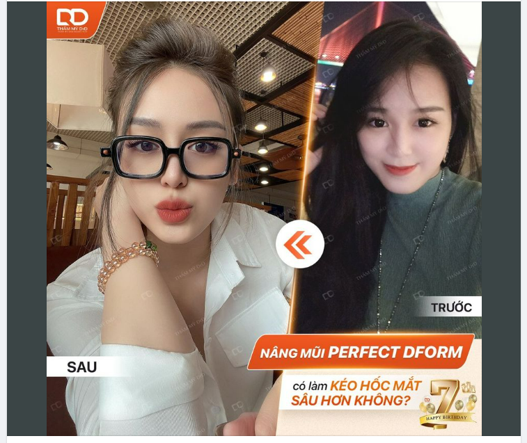 NÂNG MŨI CÓ KÉO HỐC MẮT SÂU HƠN KHÔNG