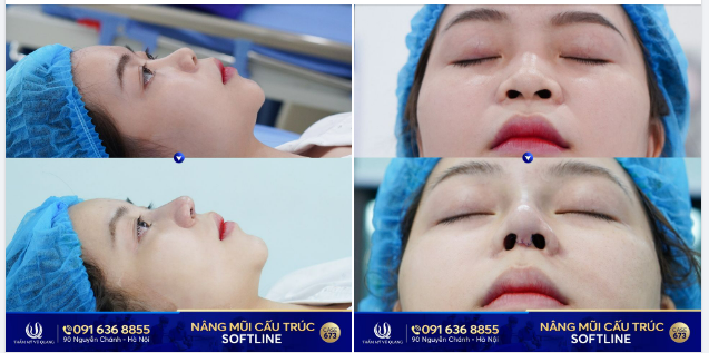 Nâng mũi cực xinh cho bạn gái hotgirl kế toán 2002