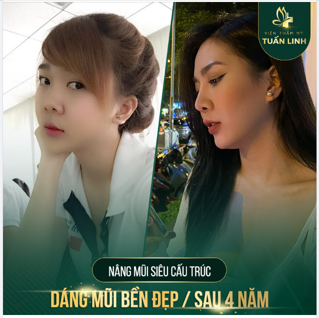 Nâng mũi để xinh đẹp giúp cô nàng 9X gặt hái được nhiều thành công trong cuộc sống!!!