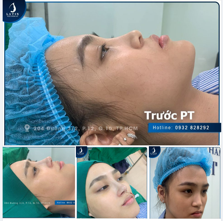 NÂNG MŨI NHẸ NHÀNG - ĐẸP NGÀN SẮC XUÂN
