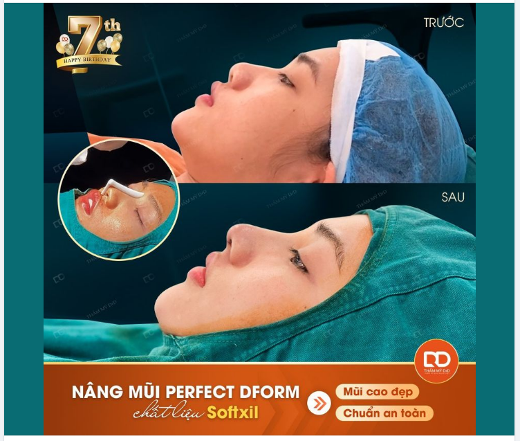 NÂNG MŨI PERFECT DFORM BẰNG CHẤT LIỆU SOFTXIL