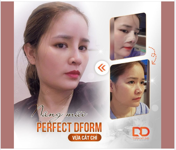 NÂNG MŨI PERFECT DFORM không phải là dáng mũi có chi phí