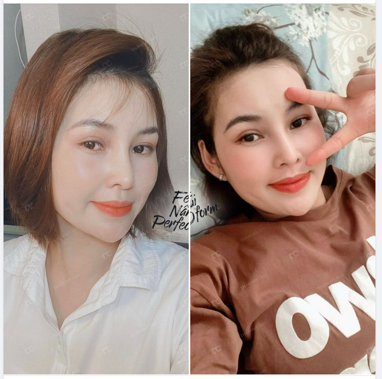 Nâng mũi Perfect Dform vẫn luôn là dịch vụ nâng mũi được yêu thích nhất tại DrD.