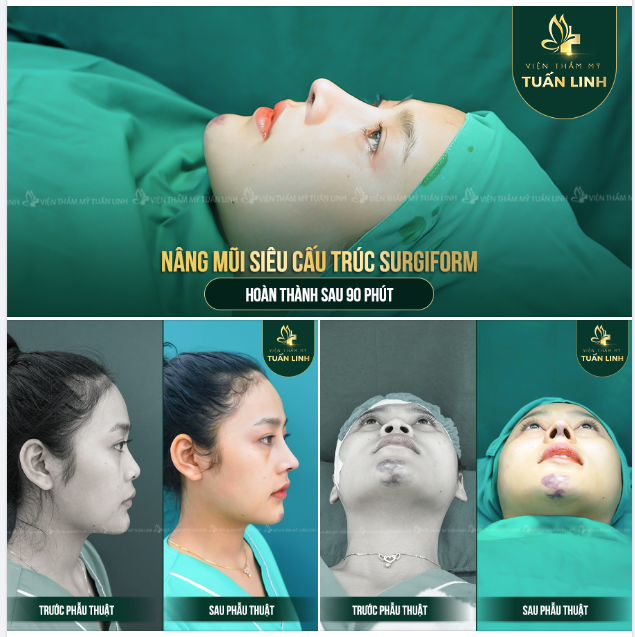NÂNG MŨI SIÊU CẤU TRÚC SURGIFORM